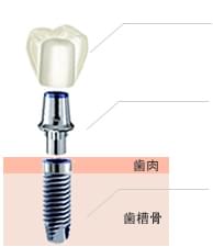 インプラント