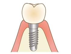 インプラント