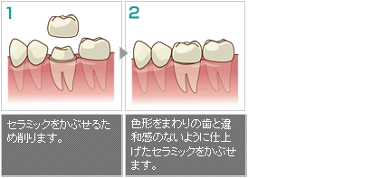 オールセラミッククラウン