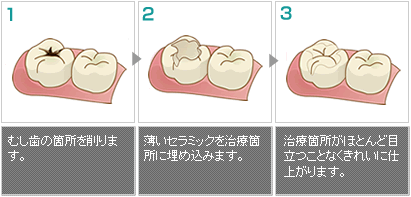 オールセラミックインレー